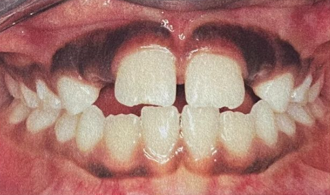 Missing Lateral Incisors